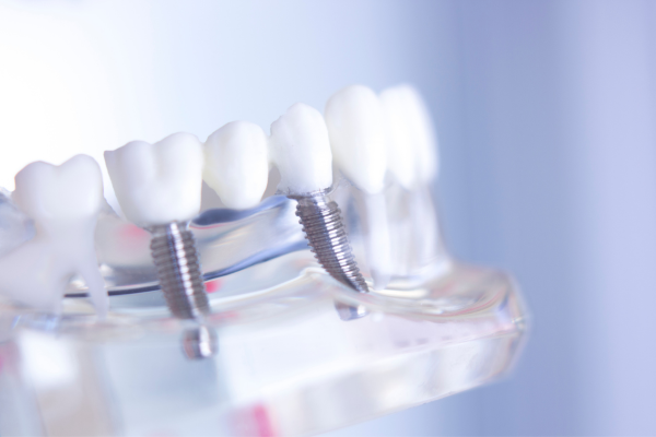 How Crowns and Bridges Restore Functionality to Your Teeth